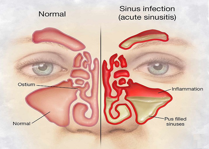sinus infection blocked nose