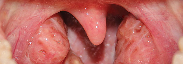 bumps on pharynx